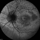 Cystoid Macular Edema (CME)